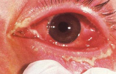 VIÊM MỦ NỘI NHÃN NỘI SINH - TRIỆU CHỨNG, NGUYÊN NHÂN VÀ ĐIỀU TRỊ